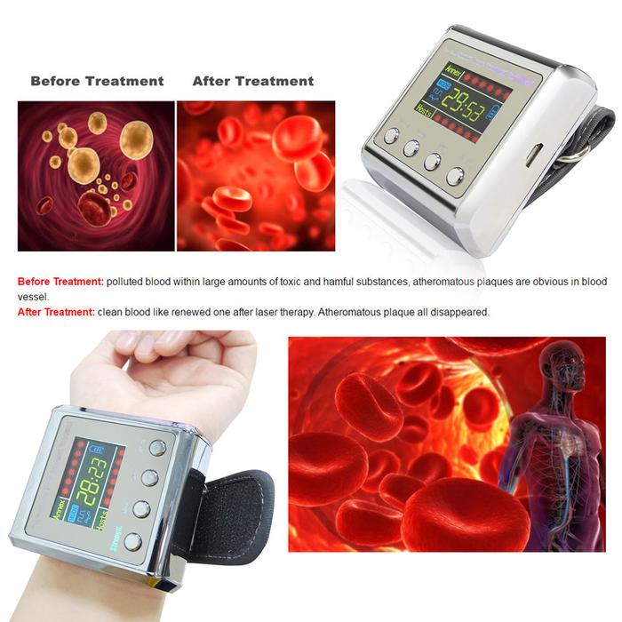 650nm Jam Tangan Terapi Laser Dioda Pergelangan Tangan Fisioterapi