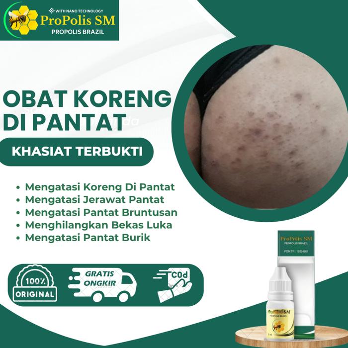 OBAT KORENG DI PANTAT, JERAWAT PANTAT, GATAL DI PANTAT, SALEP PANTAT BRUNTUSAN, PANTAT BURIK, PENGHA