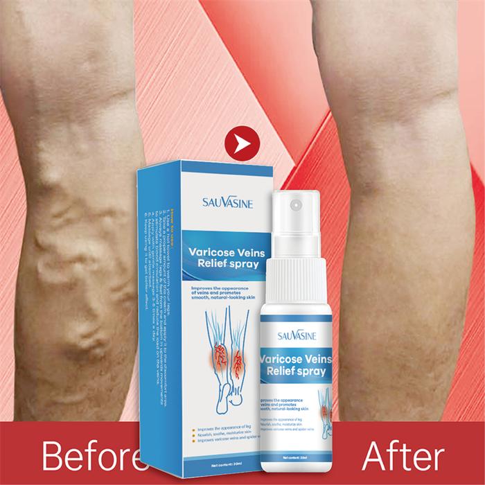 Varicose Veins Relief Spray Vasculitis Phlebitis Spider Pain Relief