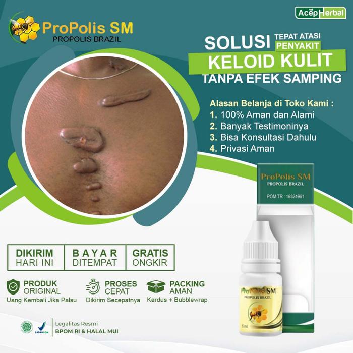 PROPOLIS SM - OBAT KELOID, OBAT KELOID LUKA TINDIK, OBAT KUTIL, OBAT DAGING TUMBUH, OBAT KELOID DI T