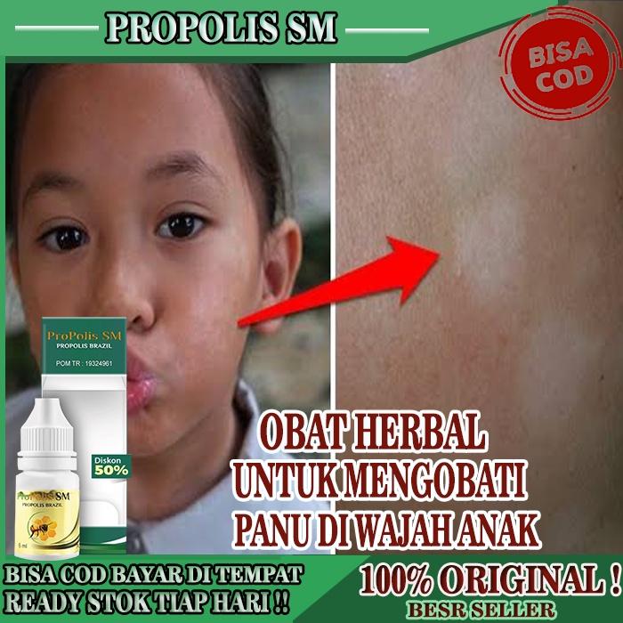 OBAT PANU DI WAJAH ANAK, OBAT PANU ANAK, OBAT KULIT PANUAN PADA BAYI, OBAT OLES KURAP PANU KULIT GAT