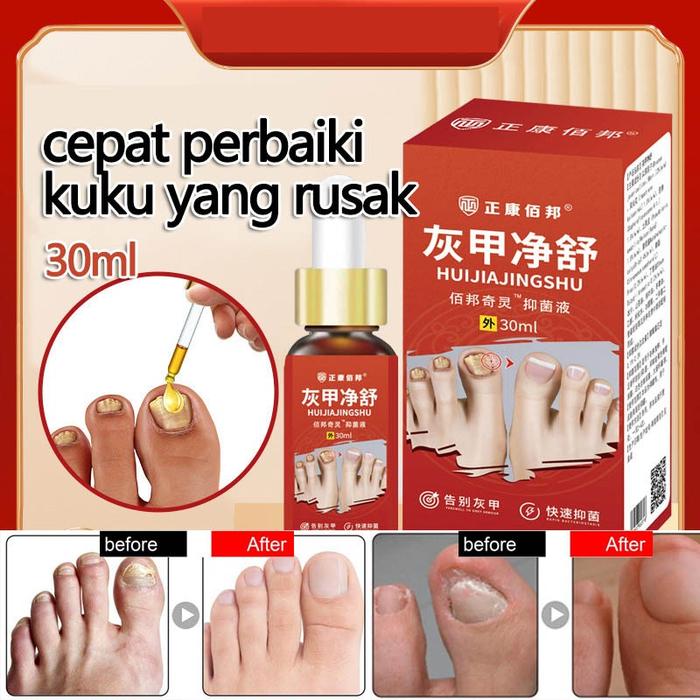 Obat Kuku Busuk Dan Hitam Obat Cantengan Jempol Kaki Kuku Jamur Dan Rusak Vitamin Salep Perawatan Ku