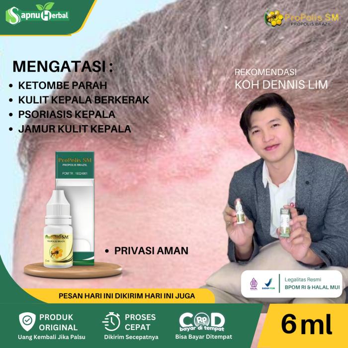 OBAT PSORIASIS KULIT KEPALA, OBAT PSORIASIS KEPALA, OBAT KULIT KEPALA BERSISIK, OBAT KULIT KEPALA BE