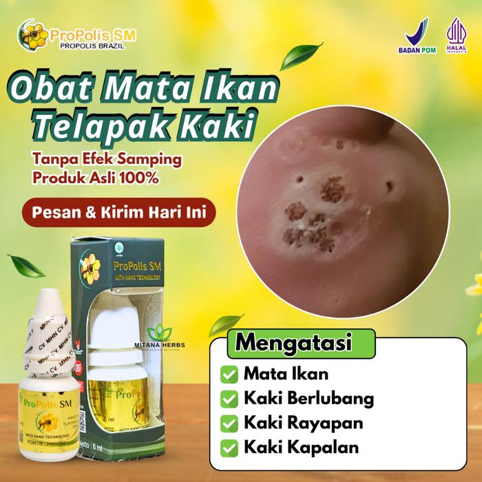 OBAT MATA IKAN TELAPAK KAKI OBAT KAKI KAPALAN OBAT KAKI RAYAPAN TELAPAK KAKI BOLONG PECAH PECAH