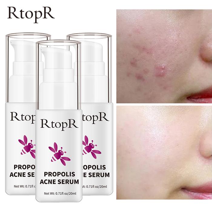 RtopR 3PCS Propolis Repair Acne Brightening Serum Acne Scar Spots