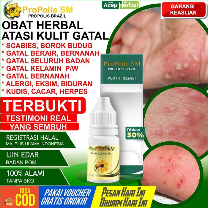 OBAT SCABIES KULIT BOROK BERNANAH CENANG BUDUG UNTUK SELURUH BADAN OBAT TETES KULIT BOROK KORENGAN P