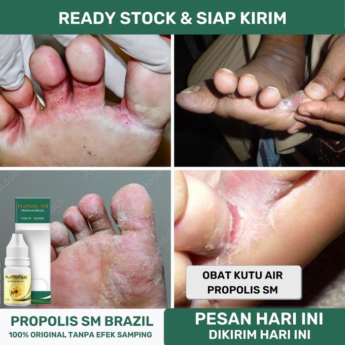 OBAT KUTU AIR DI JARI TANGAN DAN KAKI, OBAT PENGHILANG KUTU AIR, OBAT GATAL KAKI, OBAT JAMUR KAKI, O