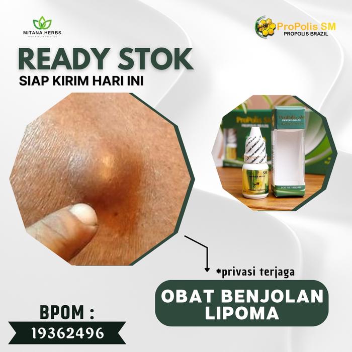 MITANA HERBAL - OBAT BENJOLAN LIPOMA - OBAT BENJOLAN DI TANGAN - OBAT BENJOLAN DI PAYUDARA - OBAT BE