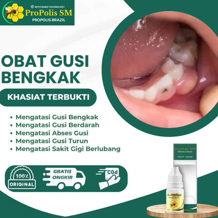 OBAT GUSI BENGKAK, GUSI BERDARAH, GUSI TURUN, ABSES GUSI, GUSI BENGKAK DAN SAKIT GIGI, RESESI GUSI,