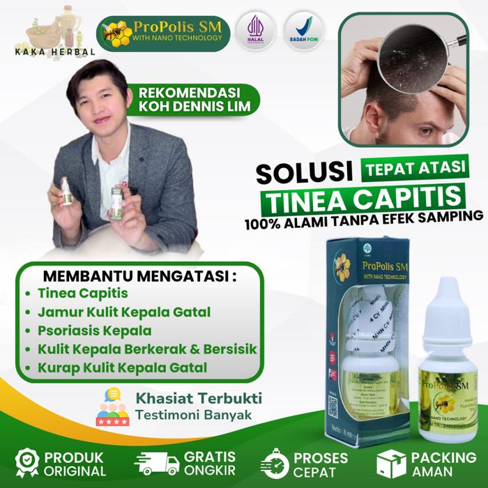 KAKA HERBAL - OBAT TINEA KAPITIS JAMUR DI KEPALA, OBAT JAMUR KULIT KEPALA, OBAT KULIT KEPALA GATAL, 