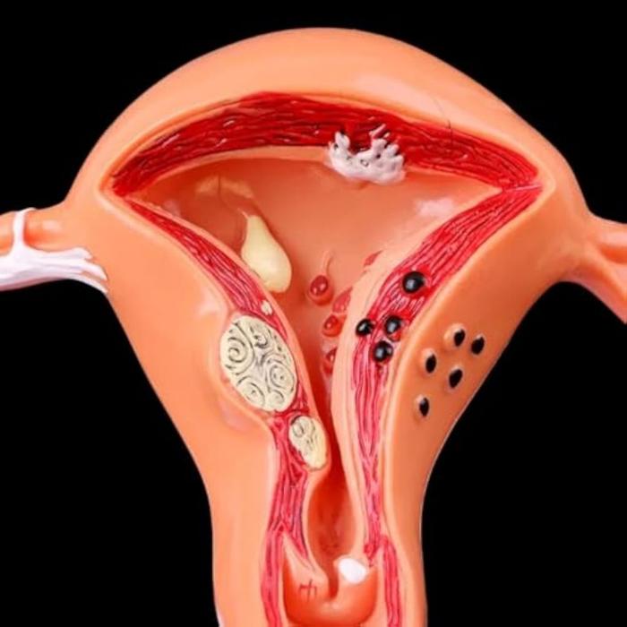 Model Anatomy Patologis Uterus Ovarium Manekin Rahim Uterus Ovary Anatomical Utk Pelajaran Fisiologi
