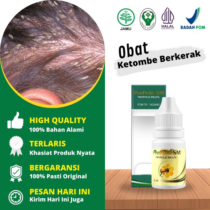 OBAT KETOMBE BERKERAK, OBAT KETOMBE RAMBUT, OBAT JAMUR KEPALA, OBAT TETES KETOMBE, OBAT OLES KETOMBE