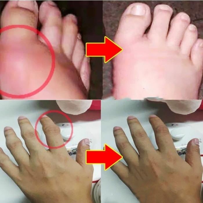 PERFECTX Joint Bone Therapy Krim Intensive Concentrate Cream Pengobatan Asam Urat Perfectx Cream 30g