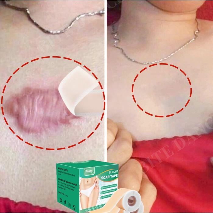Silicone scar sheet Penghilang keloid Penghilang bekas luka hitam koreng/Bekas lama/Bekas luka bakar