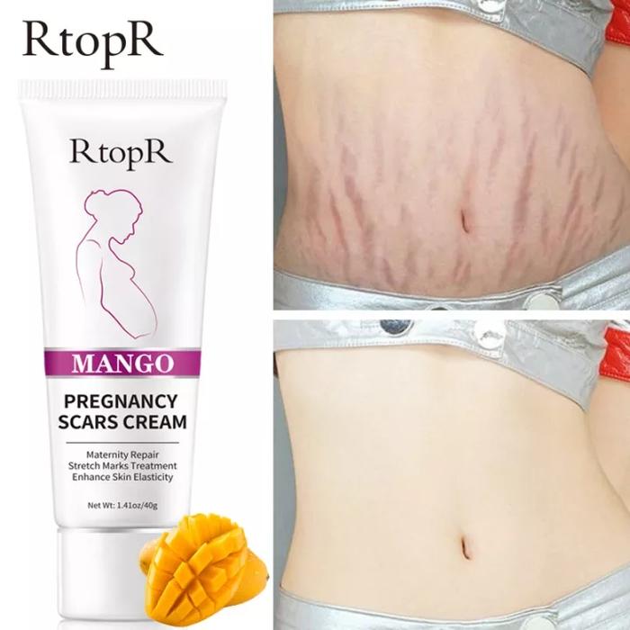 [BPOM] RtopR Mango Remove Pregnancy Scars  Stretch Marks