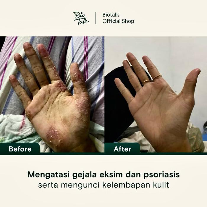 SALEP KULIT GATAL Biotalk Natural Calendula Salve| No Steroid | Meredakan Kulit Eksim Psoriasis Sens