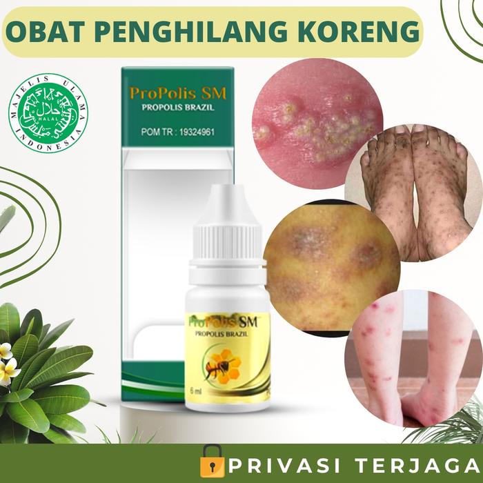 OBAT KORENG DI KAKI, OBAT DARAH MANIS, AMIS DAGING, OBAT PENGHILANG BEKAS LUKA KORENG LAMA HITAM DI