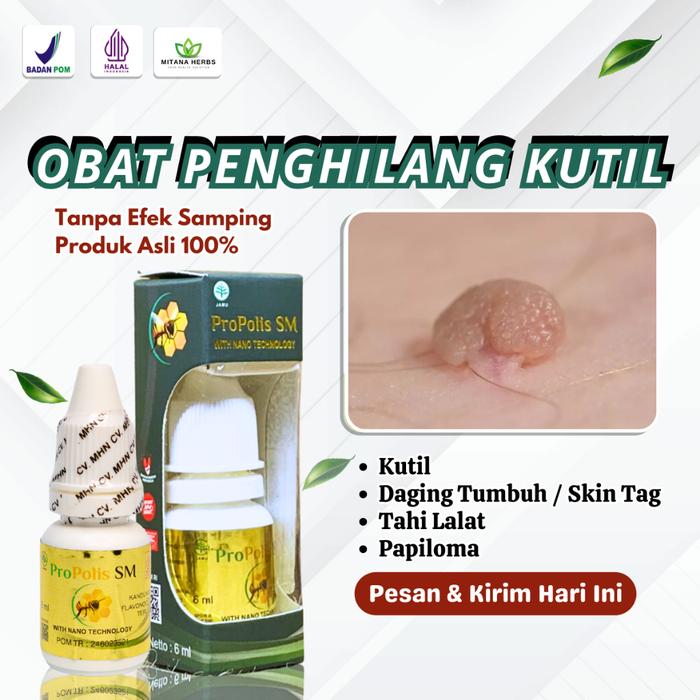 OBAT PENGHILANG KUTIL DAN TAHI LALAT - OBAT PENGHILANG KUTIL DI LEHER - OBAT PENGHILANG KUTIL DI WAJ