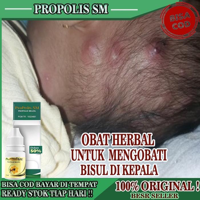 OBAT BISUL DI KEPALA, OBAT BISUL ANAK DI KEPALA, OBAT PENGERING BENJOLAN BERNANAH DI KEPALA, OBAT PE
