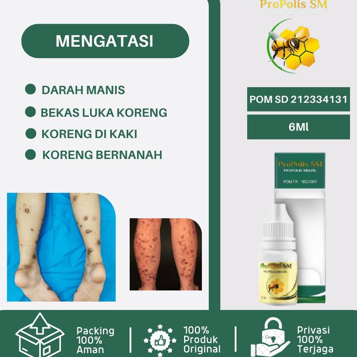 OBAT DARAH MANIS, OBAT GATAL PRURIGO, OBAT BEKAS KORENG/LUKA, OBAT KORENG DI KAKI, OBAT KORENG HITAM