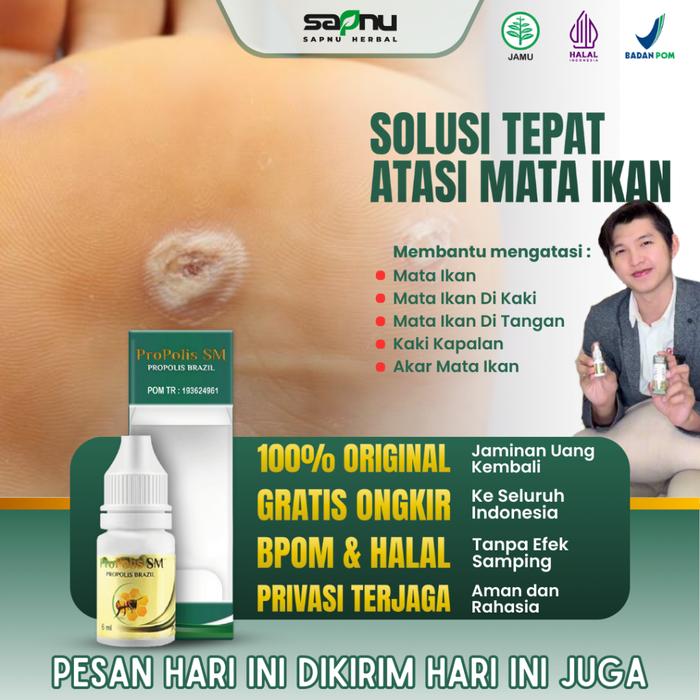 OBAT MATA IKAN PADA TELAPAK KAKI, OBAT PENGHILANG MATA IKAN DI TELAPAK KAKI / TANGAN, OBAT MATA IKAN