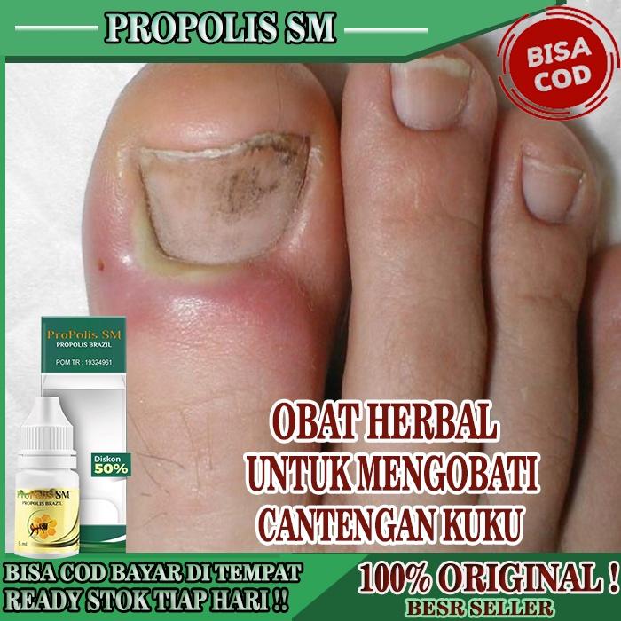OBAT CANTENGAN KUKU JEMPOL KAKI & TANGAN , OBAT KUKU JEMPOL KAKI CANTENGAN , KUKU BENGKAK BERNANAH N