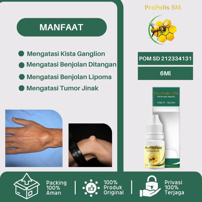 OBAT KISTA GANGLION, BENJOLAN GANGLION, BENJOLAN DI TANGAN, BENJOLAN DI PERGELANGAN TANGAN, MENGECIL