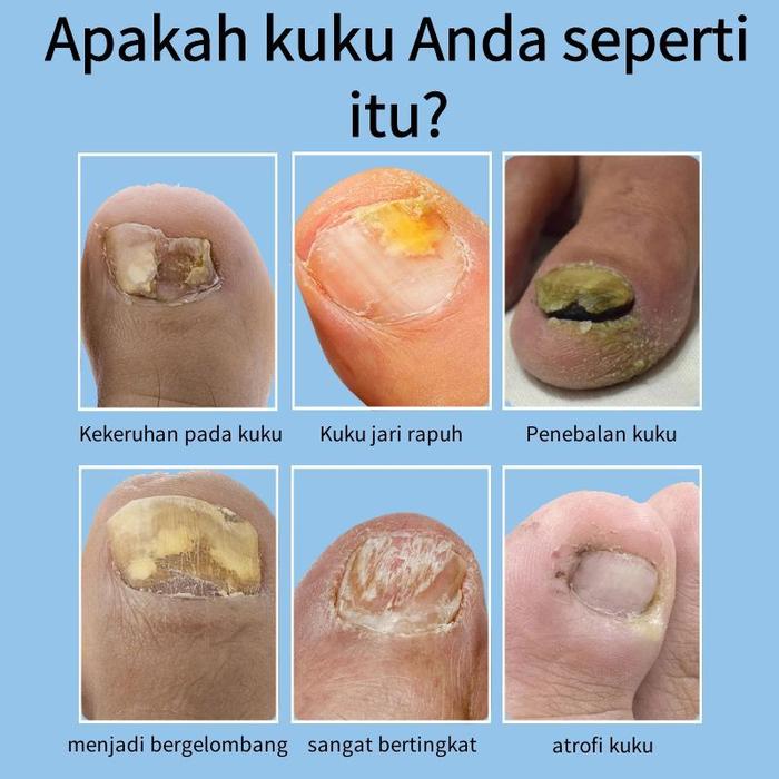 Obat Jamur Kuku Obat Kuku Jamur Dan Rusak Penghilang Jamur Kuku Gel Anti Infeksi Obat Kuku Rusak Pem