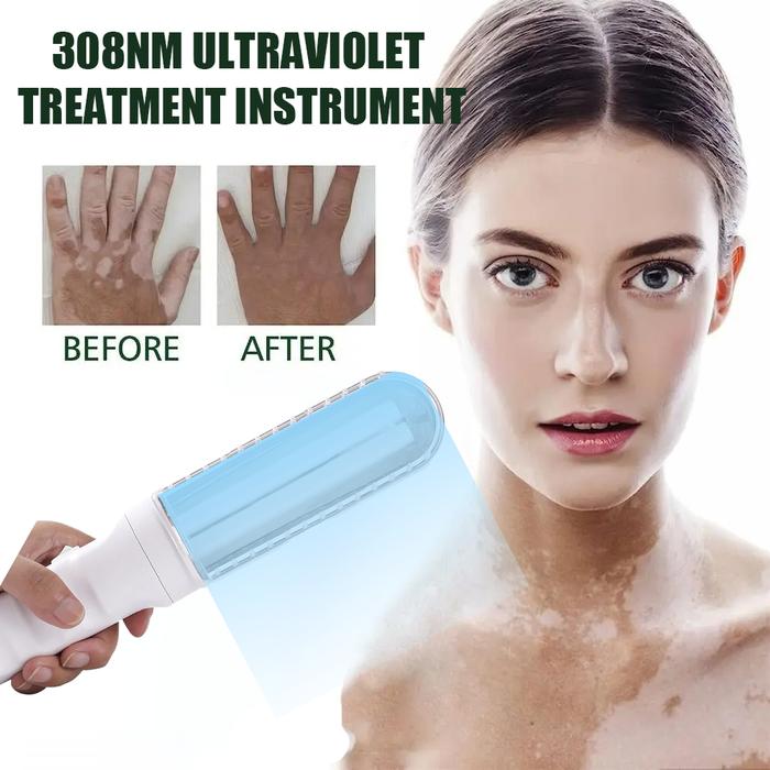 UVB Lamp UV for Vitiligo Psoriasis White Spots Skin Disease311nm Ultraviolet Phototherapy Instrument