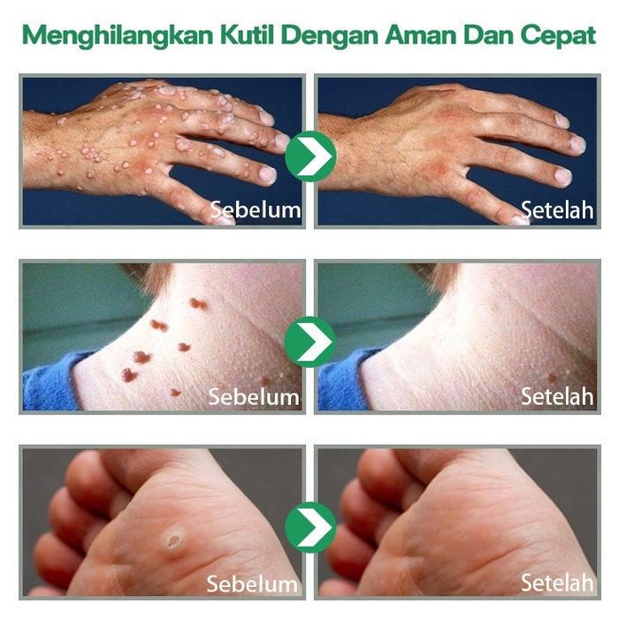 Obat Penghilang Tahi Lalat Mata Ikan 10ml Cairan Obat Untuk Kutil Salep Untuk Kapalan Kaki Cairan An