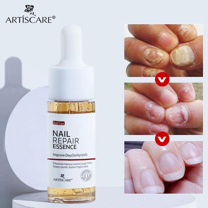 ARTISCARE Nail Repair Essence Anti Fungal Serum Nail Treatment Remove