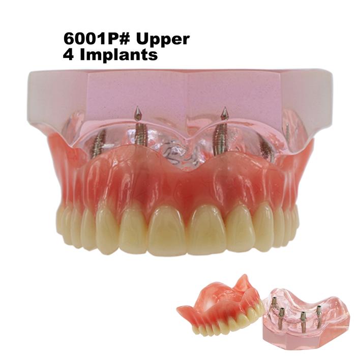 Model Gigi Implan Gigi M6001 Typodont Merah Muda Overdenture 4 Implan