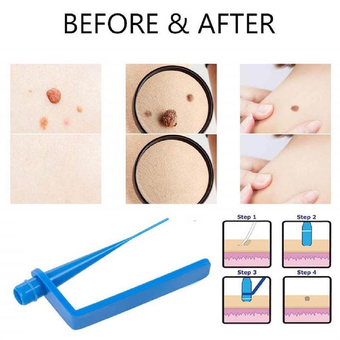 1 Set  Obat Kutil Penghilang Tahi Lalat Skin Tag Mole Wart Remover Tools Mole Wart Remover Tools Kit