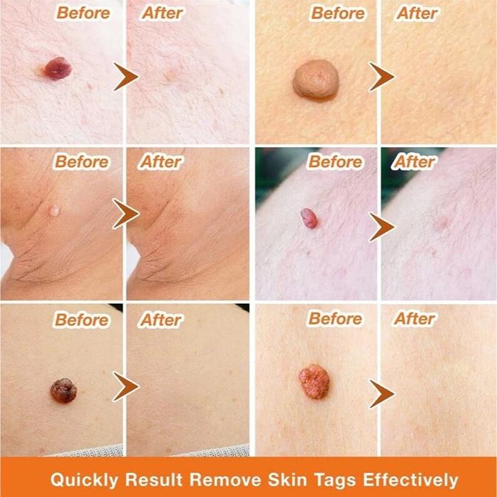Serum Gel Penghilang Tahi Lalat Kutil Milia Tai Lalat Nevus Gel Skin Tag Remover Andeng Andeng Palin
