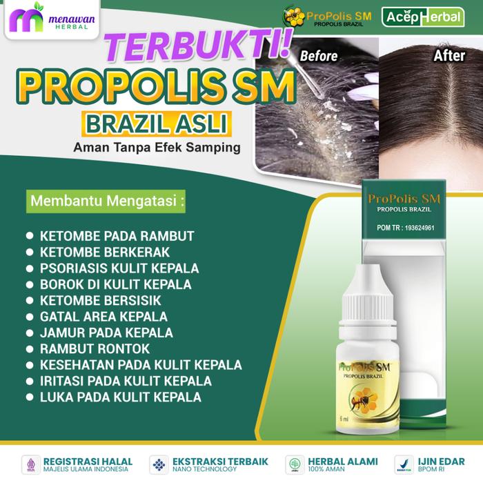 PROPOLIS SM - OBAT KETOMBE RAMBUT, OBAT KETOMBE BERKERAK, OBAT TETES KETOMBE BERSISIK, OBAT ANTI KET