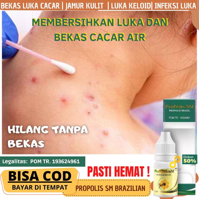 CARA MENGOBATI CACAR AIR AGAR CEPAT KERING DAN HILANG, PROPOOLIS SALEP CACAR AIR BIAR CEPAT KERING -