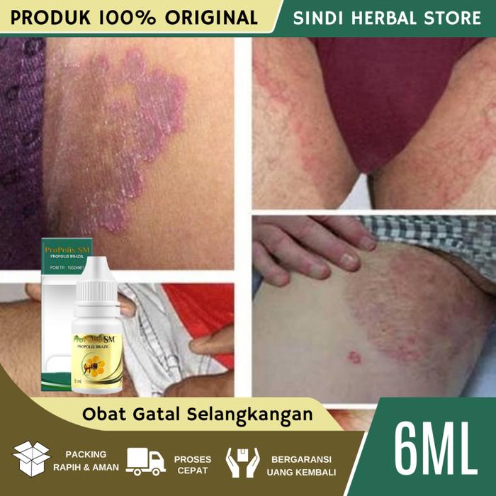 OBAT GATAL SELANGKANGAN, OBAT GATAL SELANGKANGAN HITAM DAN GATAL, OBAT GATAL SELANGKANGAN PRIA WANIT