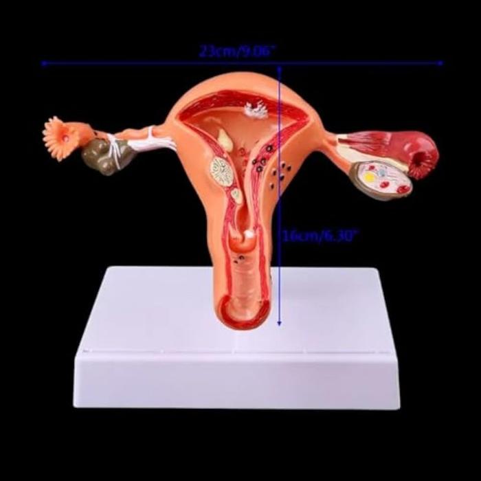 Uterus Ovary Anatomical Model Alat Peraga Model Anatomi Uterus And Ovaries Normal And Pathological