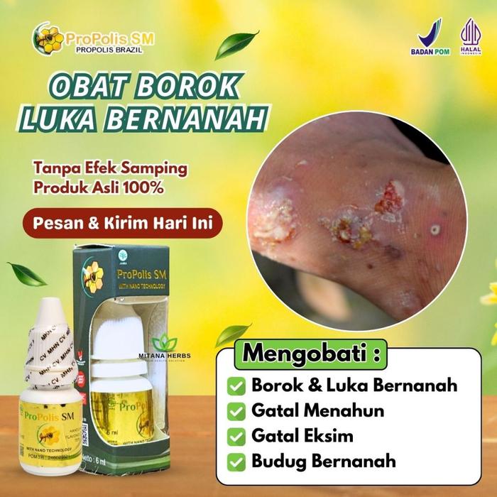 OBAT BOROK, OBAT LUKA BERNANAH, OBAT GATAL MENAHUN, OBAT GATAL BERAIR, GATAL EKSIM BERNANAH BUDUG