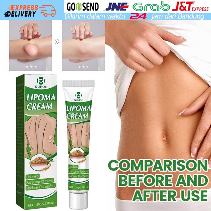 Salep Lipoma Salep Benjolan 20g - Obat Lipoma Obat Benjolan Penghilang Benjolan Aman Dan Tanpa Efek