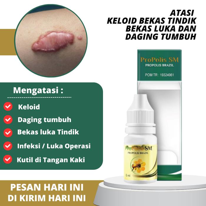 OBAT KELOID, OBAT KELOID LUKA TINDIK, OBAT KELOID DAGING TUMBUH, PENGHILANG KELOID DAGING TUMBUH, OB