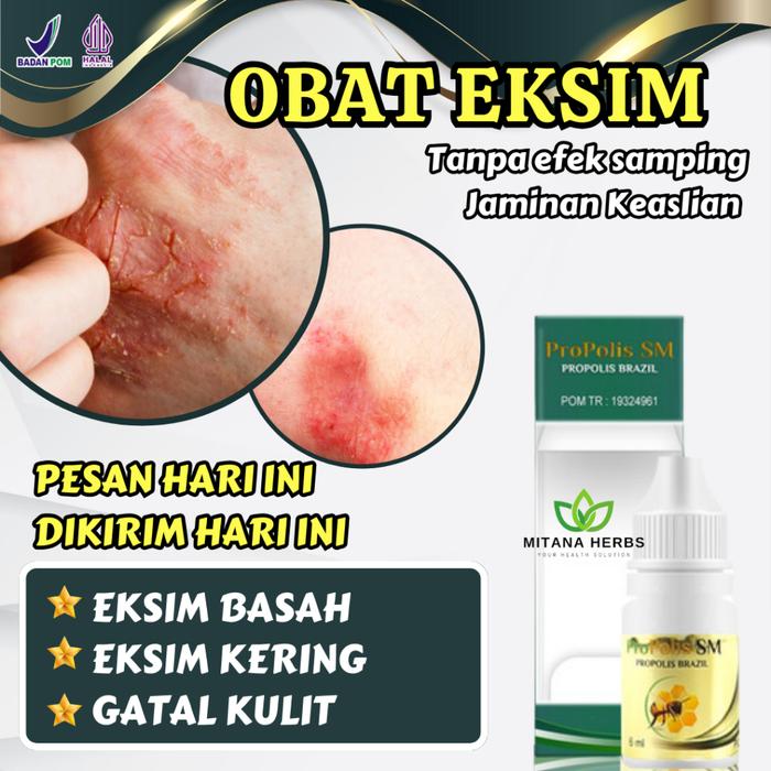 OBAT EKSIM KERING MENAHUN - OBAT EKSIM BASAH - OBAT EKSIM KERING - OBAT GATAL EKSIM - OBAT GATAL KUL