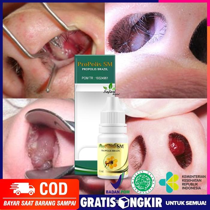 Obat Polip hidung, Sinusitis Menahun, Sering keluar cairan / lendir dari hidung, Hidung Bau Busuk, B