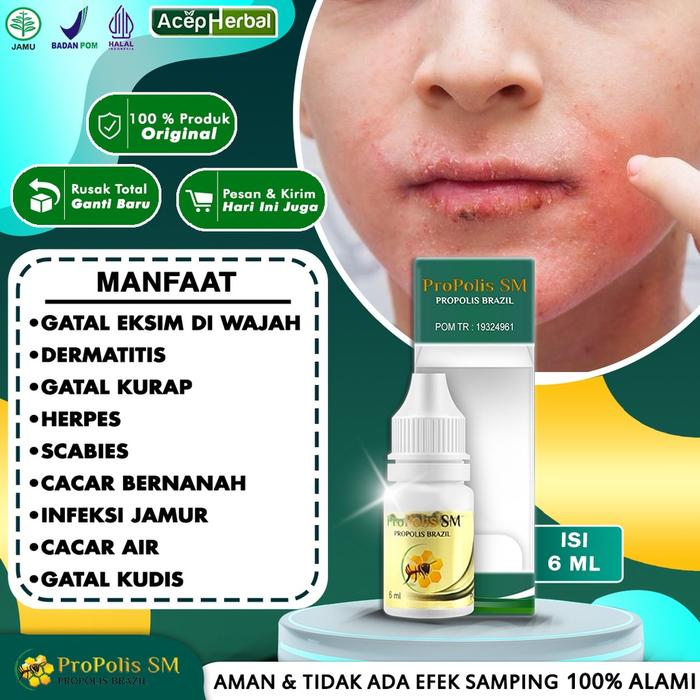 OBAT GATAL EKSIM DI WAJAH LEHER TELINGA PERGELANGAN TANGAN SIKU KAKI EXSIM KERING MENAHUN BASAH DERM