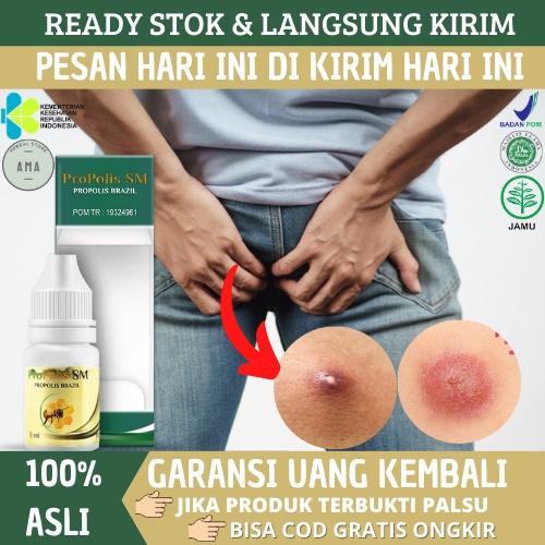 OBAT PENGEMPIS BISUL DI PANTAT, SALEP OLES BISUL DI PANTAT, OBAT BISUL DI PANTAT, OBAT BISULAN DI PA