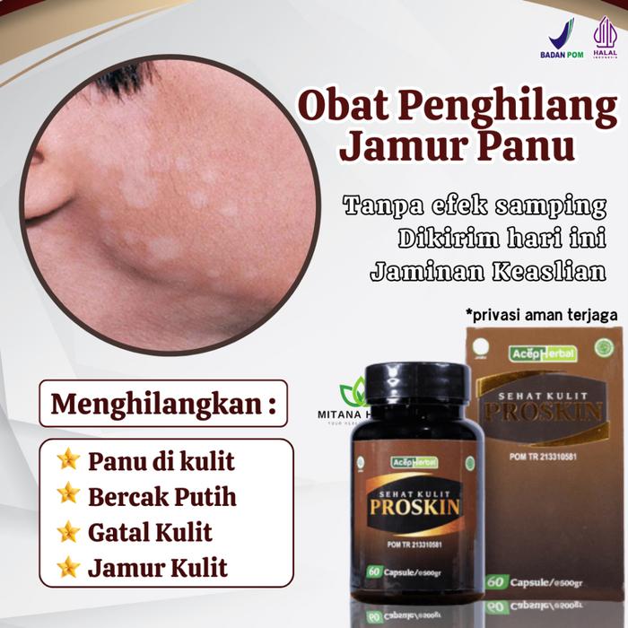 OBAT PANU, OBAT PENGHILANG PANU, OBAT PANU CAIR, SABUN PENGHILANG PANU, OBAT JAMUR KULIT, SALEP HAPU