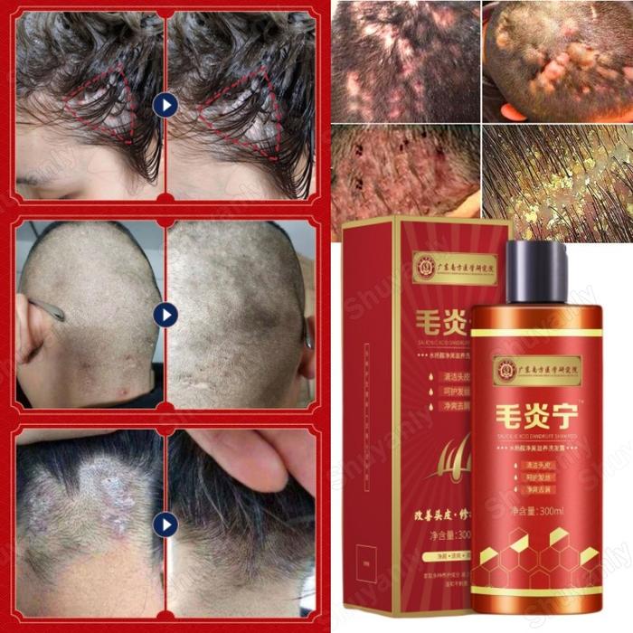 Hair Psoriasis Seborrheic Treatment Dermatitis Eczema Compound Herbal