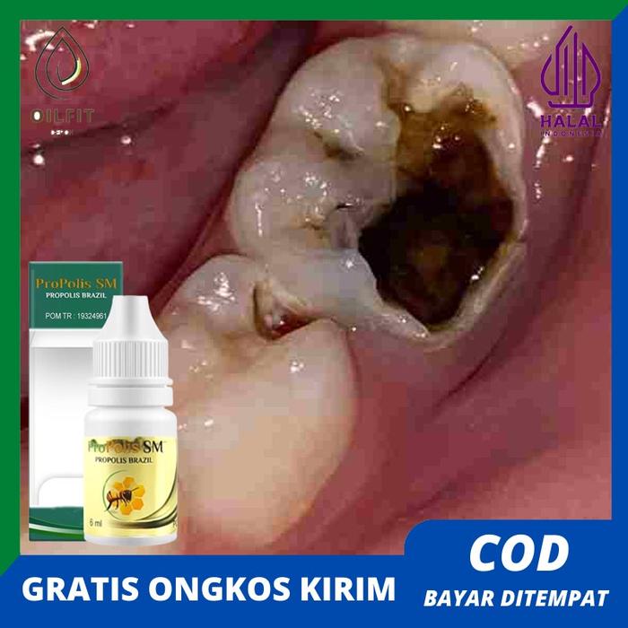 OBAT PENCABUT GIGI BERLUBANG, PERONTOK GIGI SAMPAI AKAR, PENGHANCUR GIGI BERLUBANG CEPAT SEMBUH