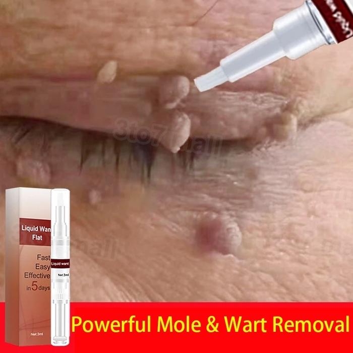 Penghilang Tahi Lalat Di Wajah Kutil Dan Tahi Lalat Skin Tag Remover Wart Removal Original Pen Untuk