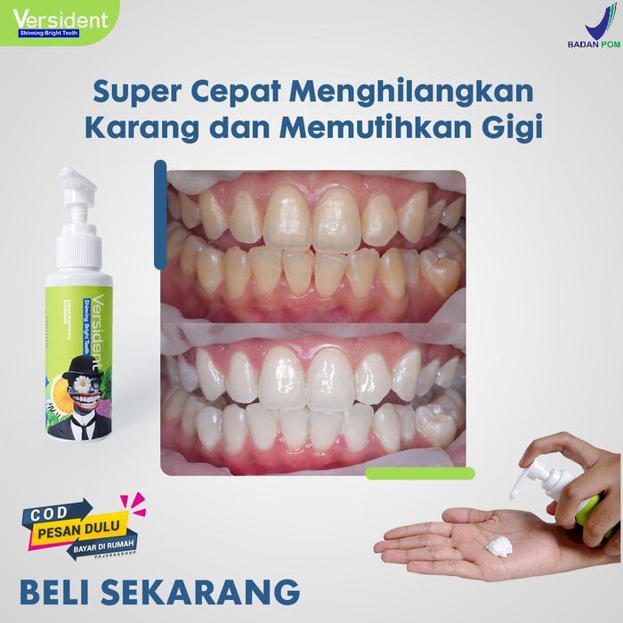TOOTH DECAY PENUMBUH GIGI OMPONG / PENGHILANG KARANG GIGI / PEMUTIH GI